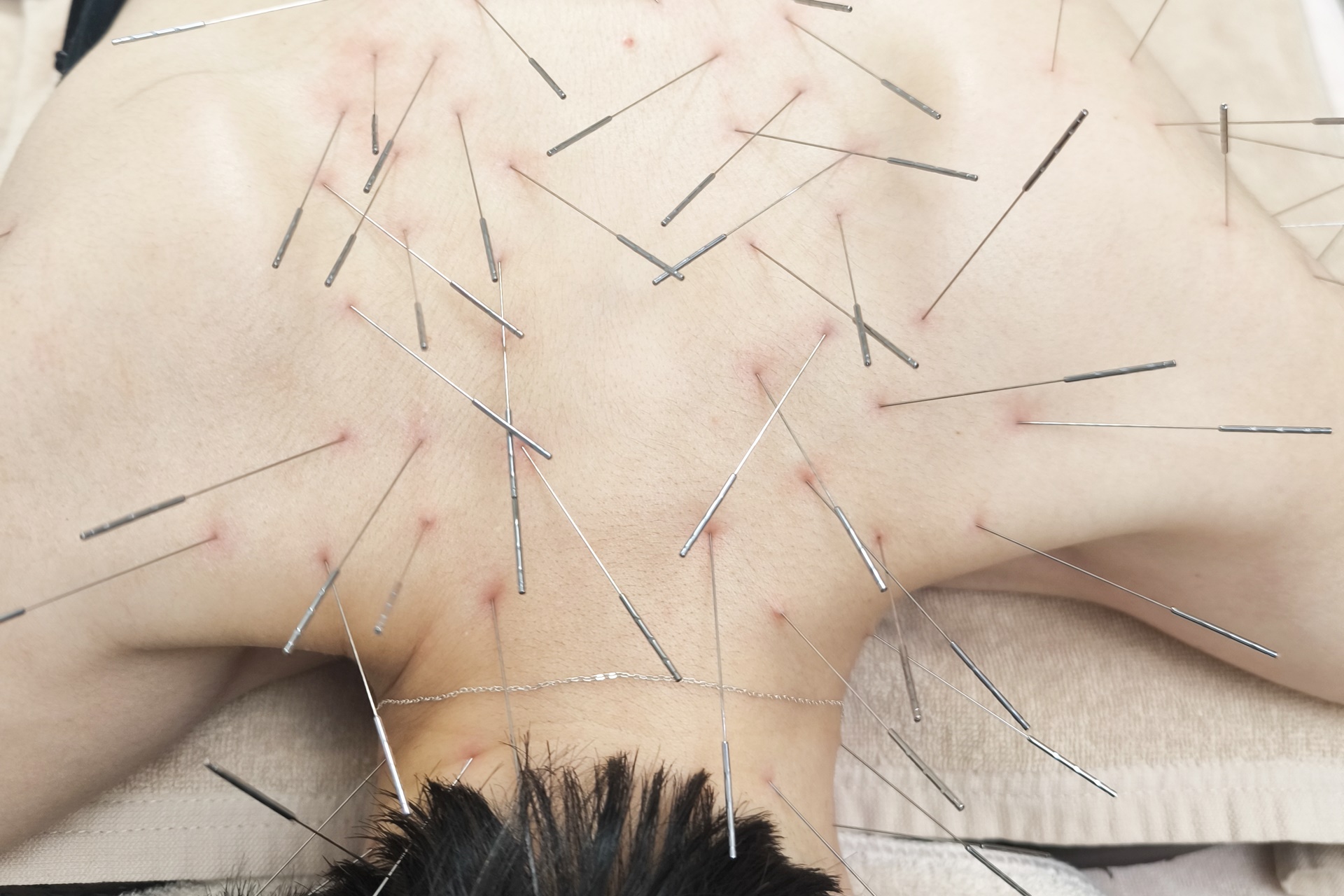 きやま鍼灸治療院  【ルート治療専門院】 ルート治療　（ロング）のメニュー画像