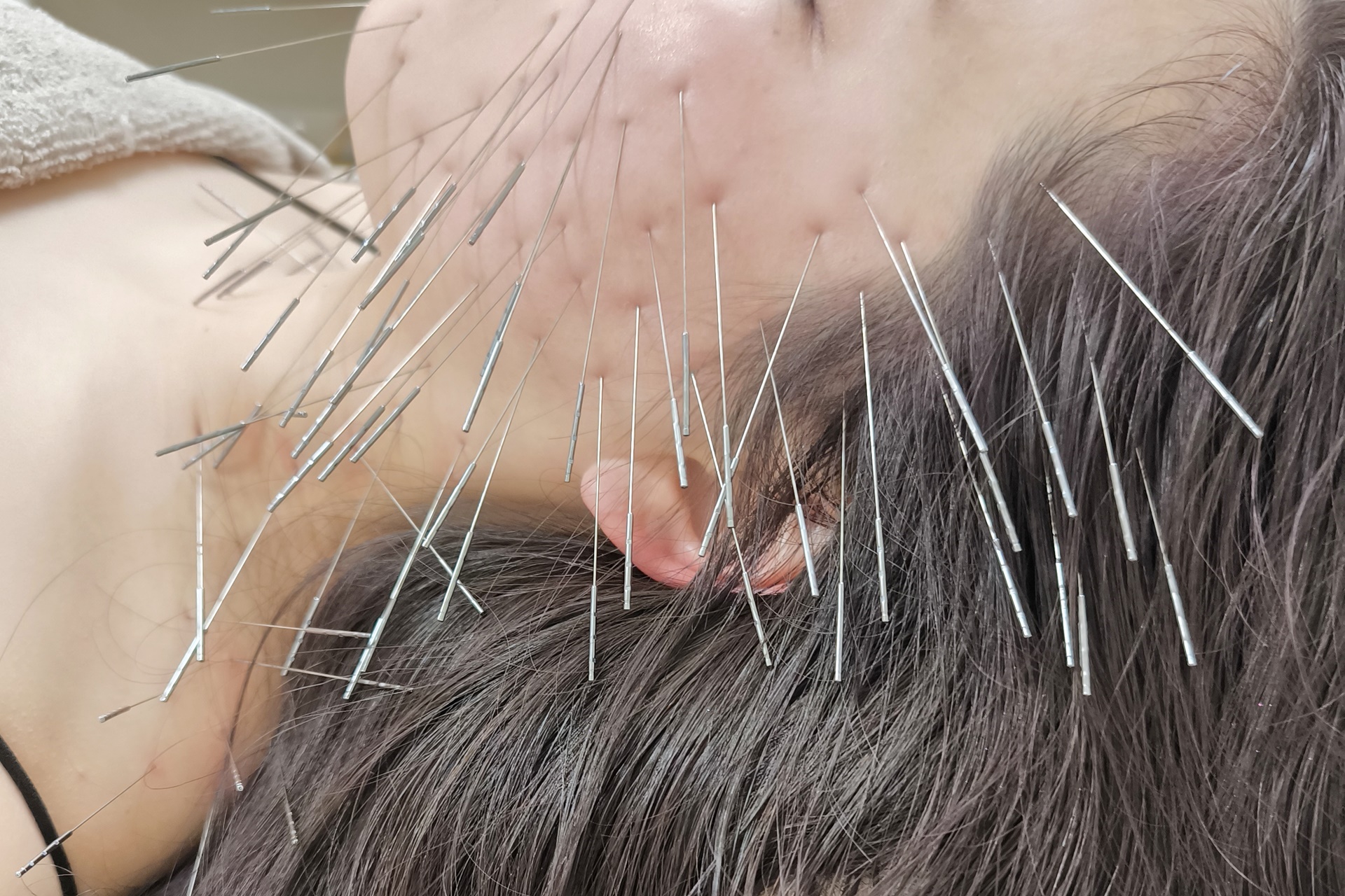 きやま鍼灸治療院  【ルート治療専門院】 ルート美容鍼のメニュー画像