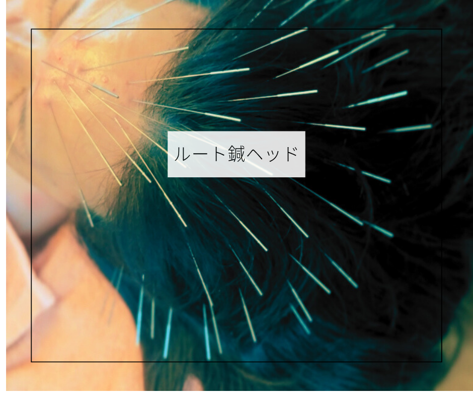 鍼灸soin de beaute 🆕ルートヘッドリリースフェイシャルのメニュー画像