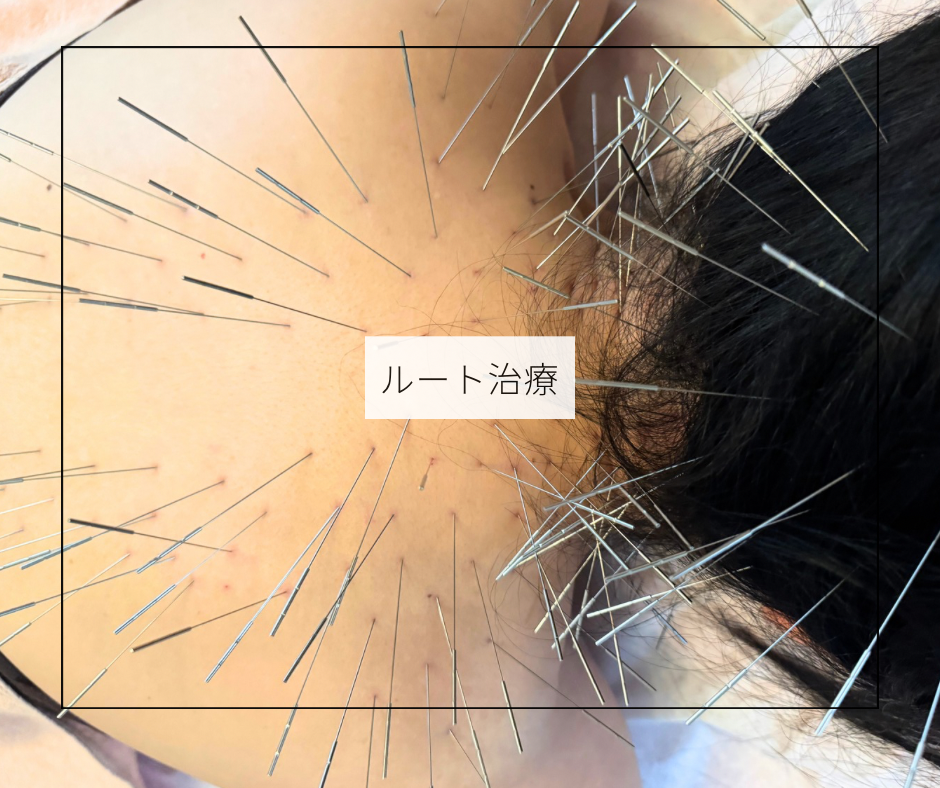 鍼灸soin de beaute 🉐ルート鍼・ボディトリートメントのメニュー画像