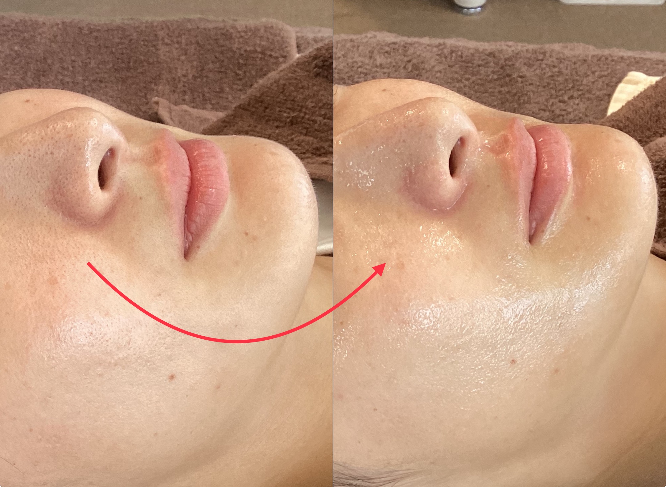 KOBE鍼灸治療院 初回お試し「毛穴引き締め美容鍼or引き締めマシーン×毛穴洗浄施術ハイドロフェイシャル」【40代50代〜】のメニュー画像