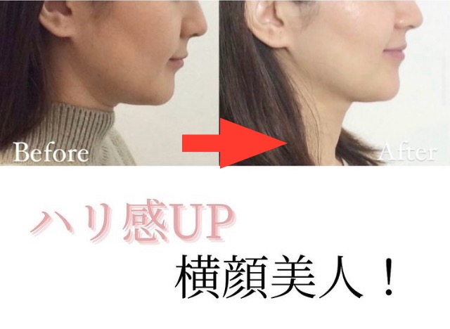 KOBE鍼灸治療院 初回お試し「ハリウッド式美容鍼®︎」 口顎周りのたるみからのほうれい線リフトアップ施術のメニュー画像