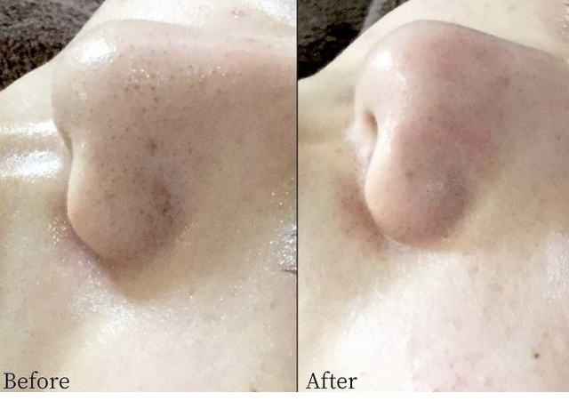 KOBE鍼灸治療院 初回お試し毛穴ケア「ハイドロフェイシャル」毛穴・開き毛穴・詰まり毛穴でお悩みの【20〜40代】のメニュー画像