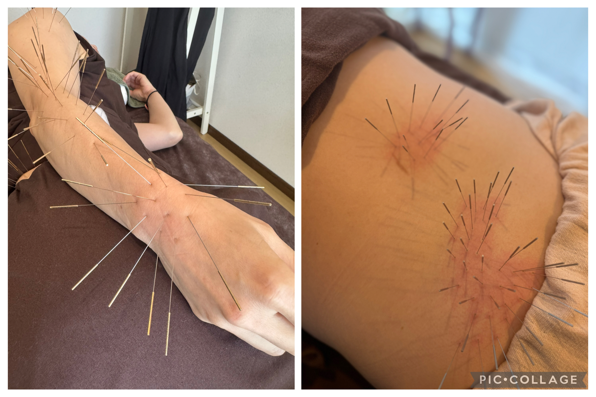 鍼処卓-taku- ｜ルート治療Sランク公認認定院｜空ルート｜浄化｜美容鍼｜吹田市 ルート鍼治療　30分のメニュー画像