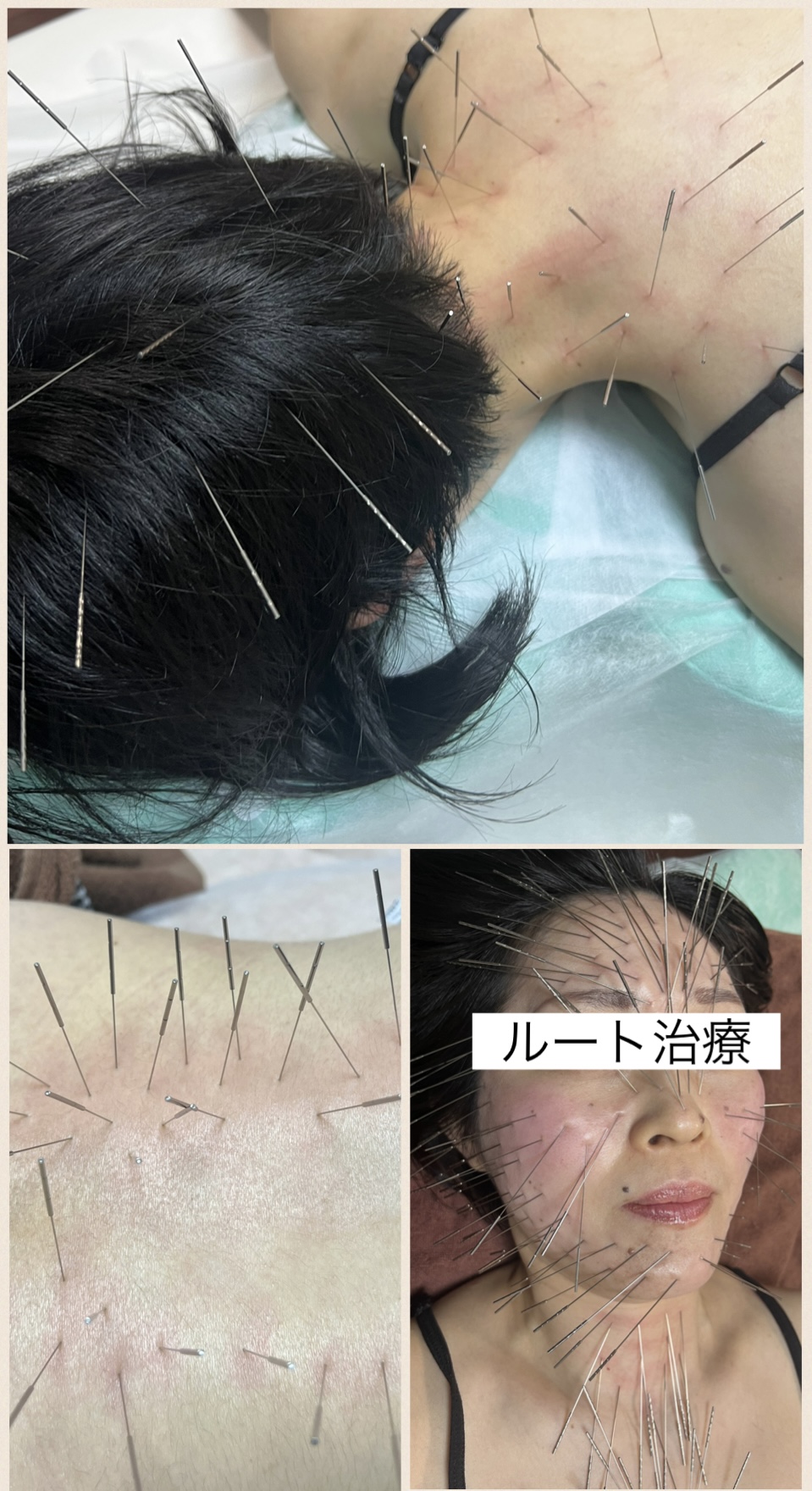ルート治療・空ルート専門院　鍼処かなしゃ ルート治療45分のメニュー画像