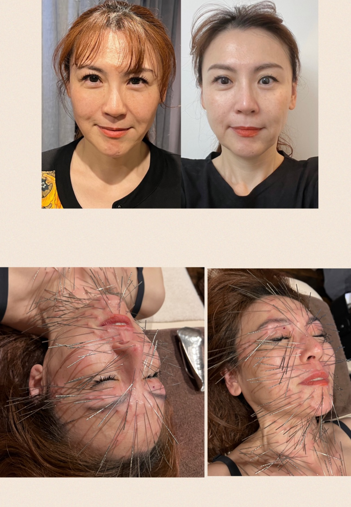 ルート治療・空ルート専門院　鍼処かなしゃ 鬼美容60分コースのメニュー画像