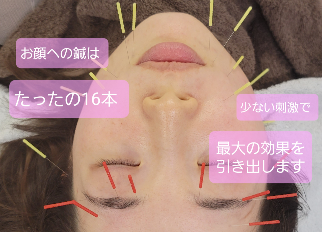 Lila鍼灸院 【オープン記念！モニター10名様限定】上田式美容鍼灸　施術体験￥3,000のメニュー画像