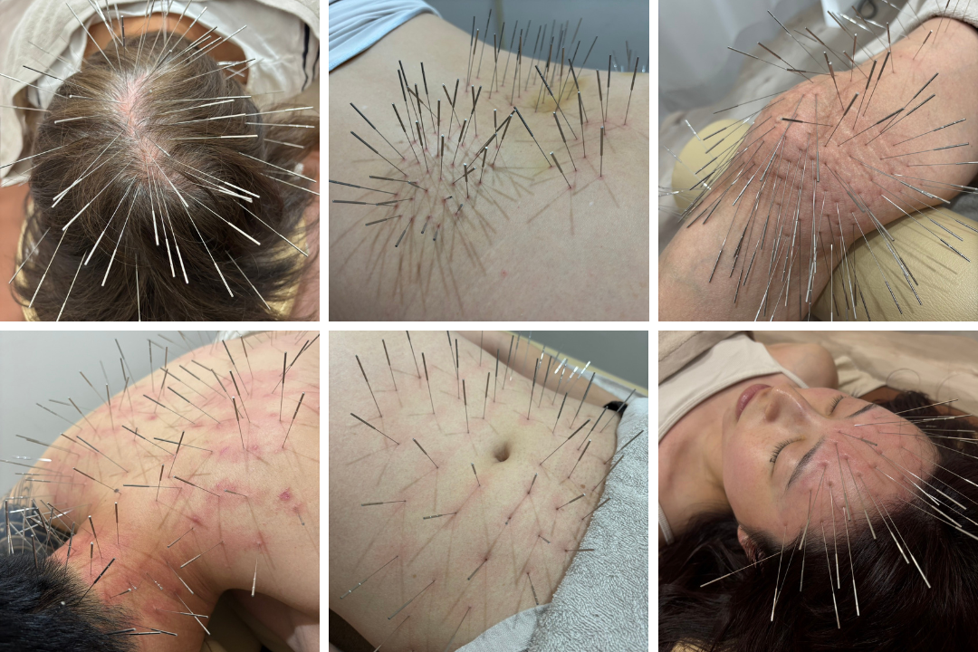 モエレ鍼灸接骨院 ルート治療60 分(ロング)のメニュー画像