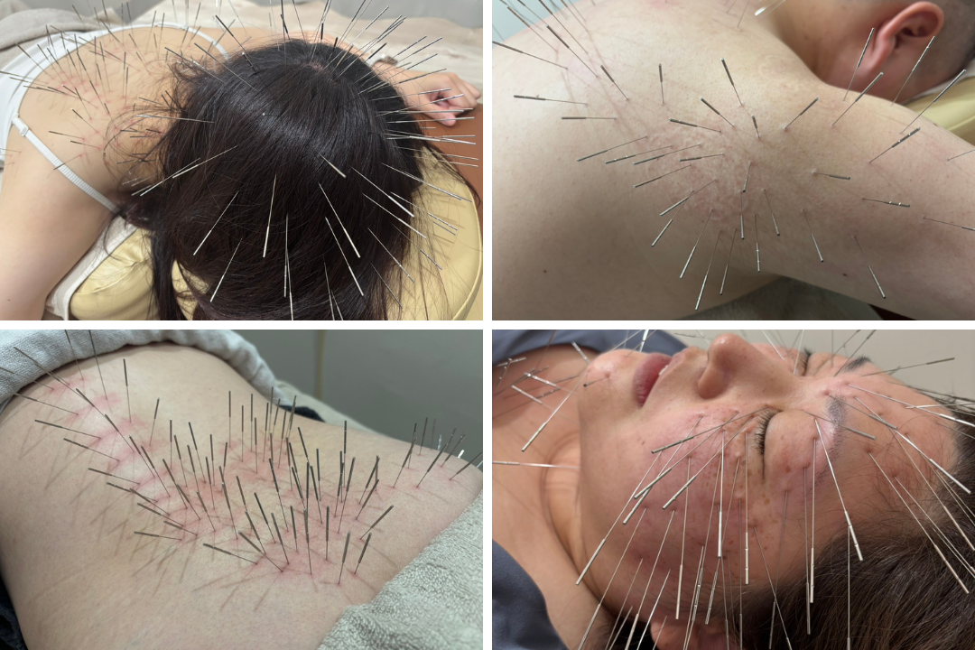 モエレ鍼灸接骨院 ルート治療45分(ベーシック)のメニュー画像