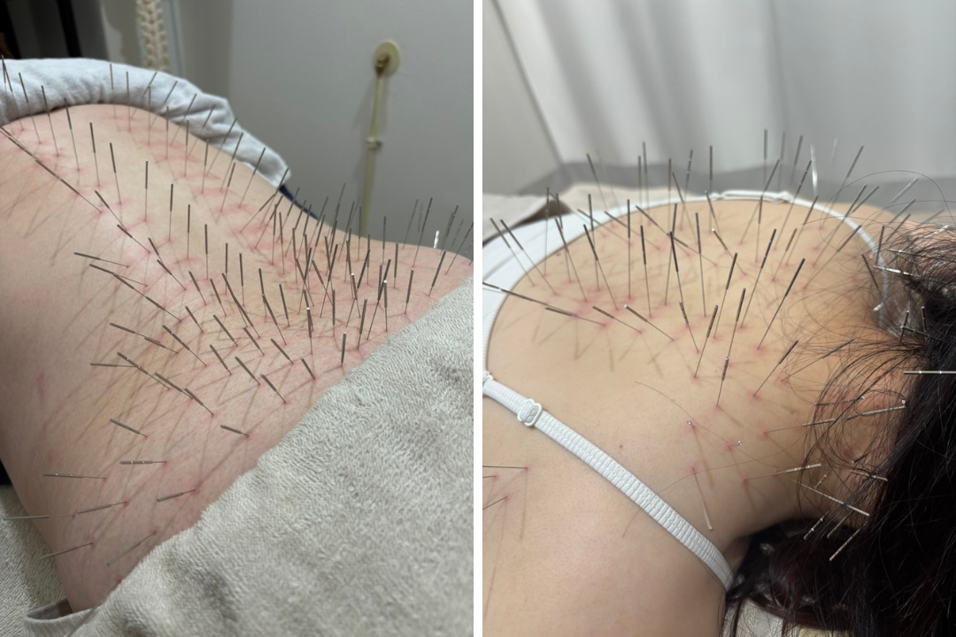 モエレ鍼灸接骨院 ルート治療30分(ショート)のメニュー画像