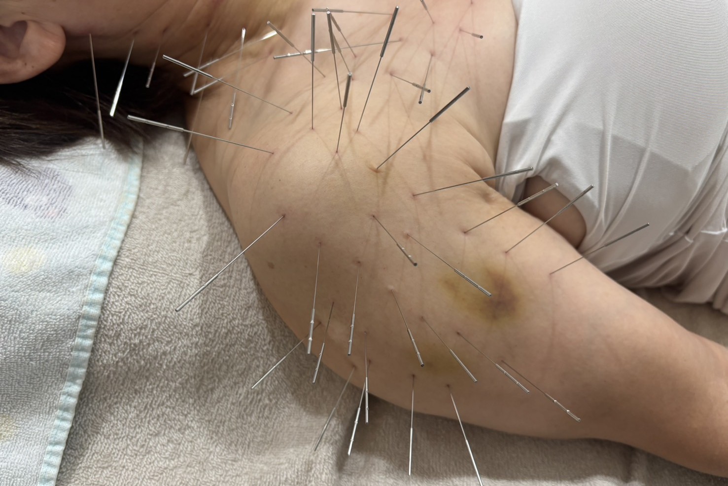 モエレ鍼灸接骨院 ルート治療15分(ベリーショート)のメニュー画像