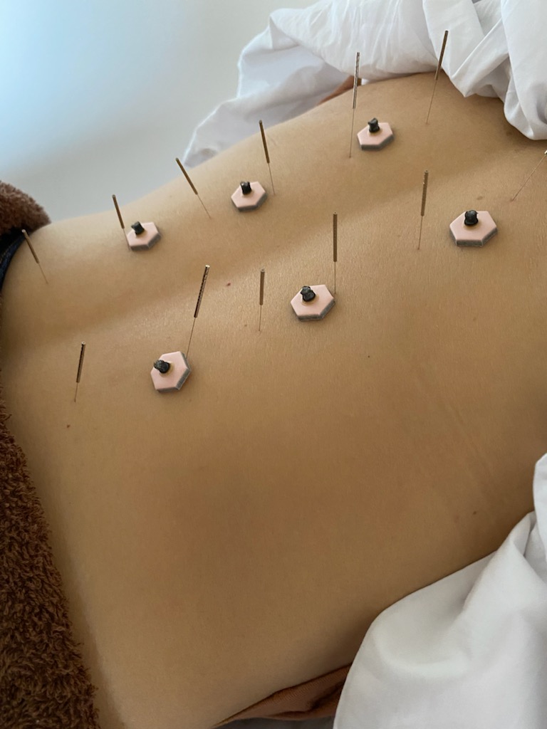 鍼灸院 侑秀 NIIGATA (新規限定)ピンポン鍼灸コースのメニュー画像