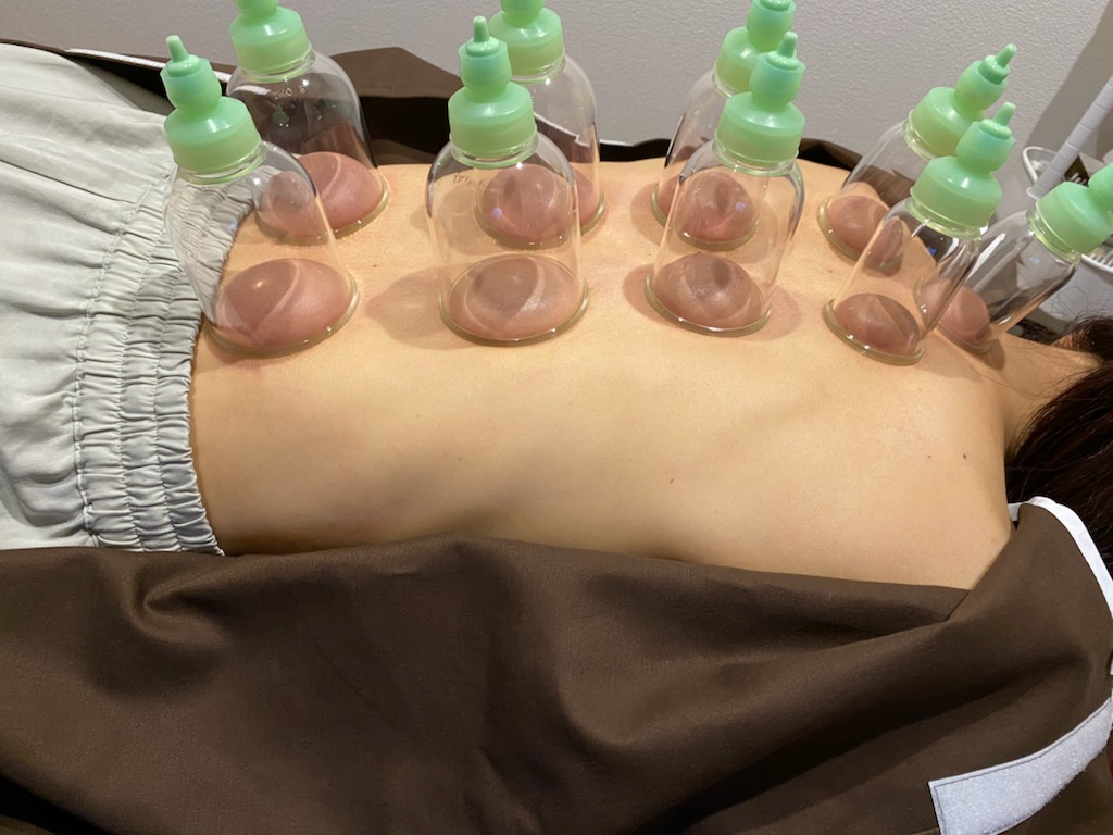 鍼灸院 侑秀 NIIGATA (新規限定)吸角鍼灸コースのメニュー画像