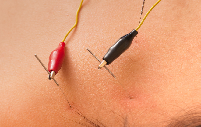 【NEW!】クイック鍼灸院さすもん 電気鍼のメニュー画像