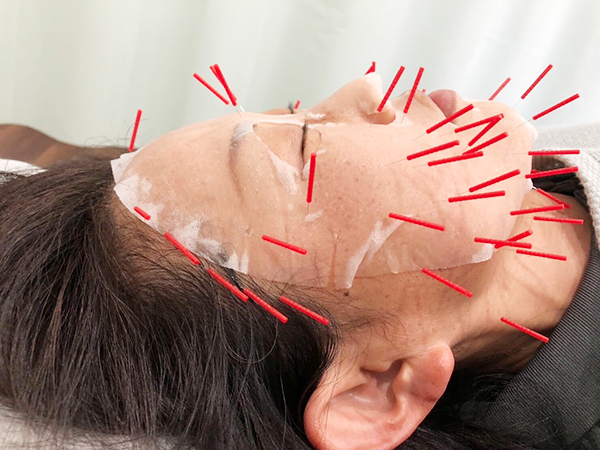 なしもと鍼灸整体治療院 美容鍼のメニュー画像