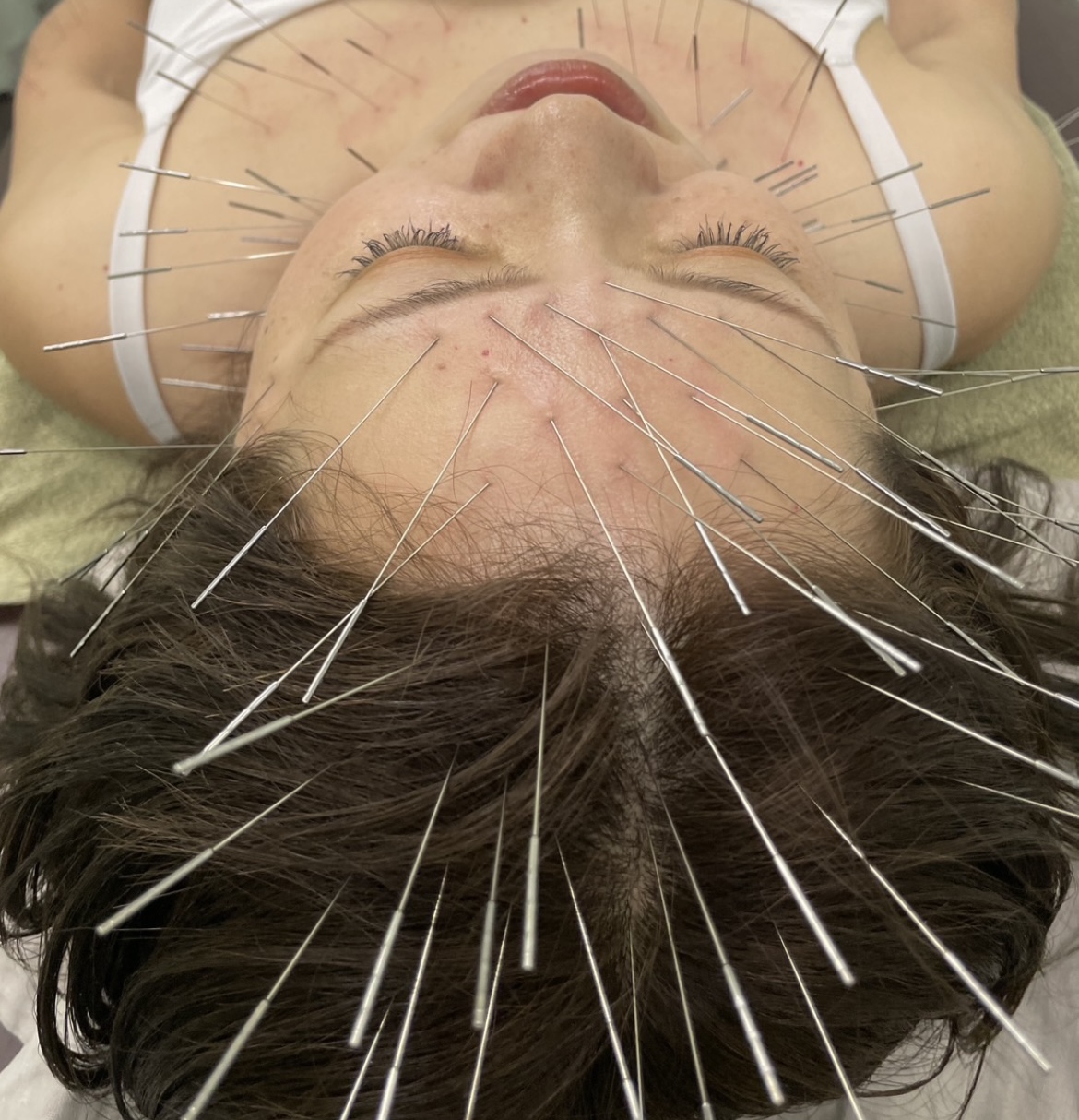 Iris鍼灸マッサージ上野院【ルート治療専門】 鬼美容鍼➕ルート治療　60分のメニュー画像