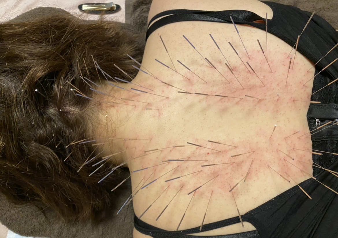 Iris鍼灸マッサージ上野院【ルート治療専門】 ルート治療　60分のメニュー画像