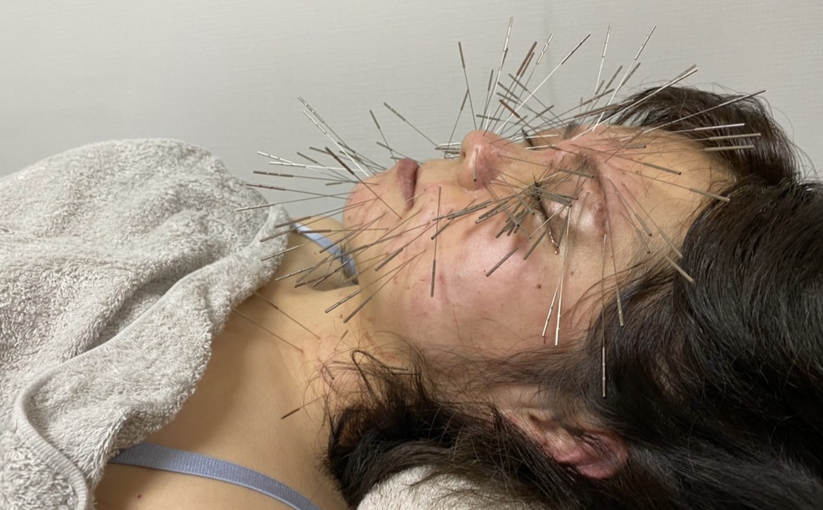 Iris鍼灸マッサージ上野院【ルート治療専門】 ルート治療　30分のメニュー画像