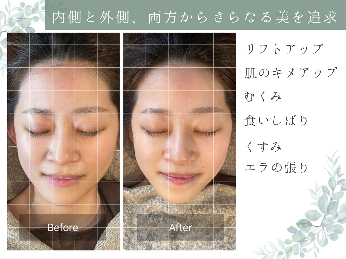 はりきゅう きざし 美顔鍼のメニュー画像