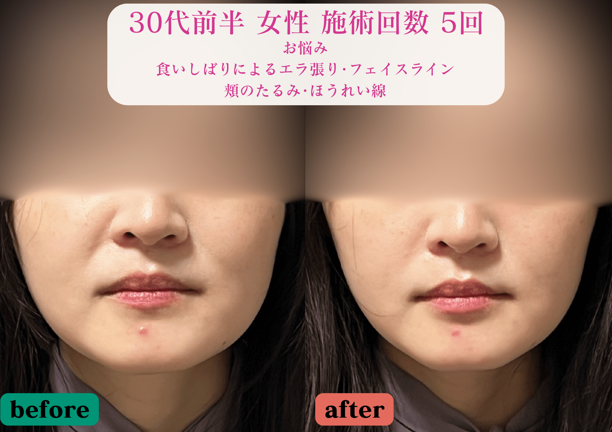 美容とカラダの鍼灸サロン やなけん 亀戸店 初回限定《エラ張り/食いしばり/輪郭改善》フェイスラインすっきり美容鍼+LEDのメニュー画像