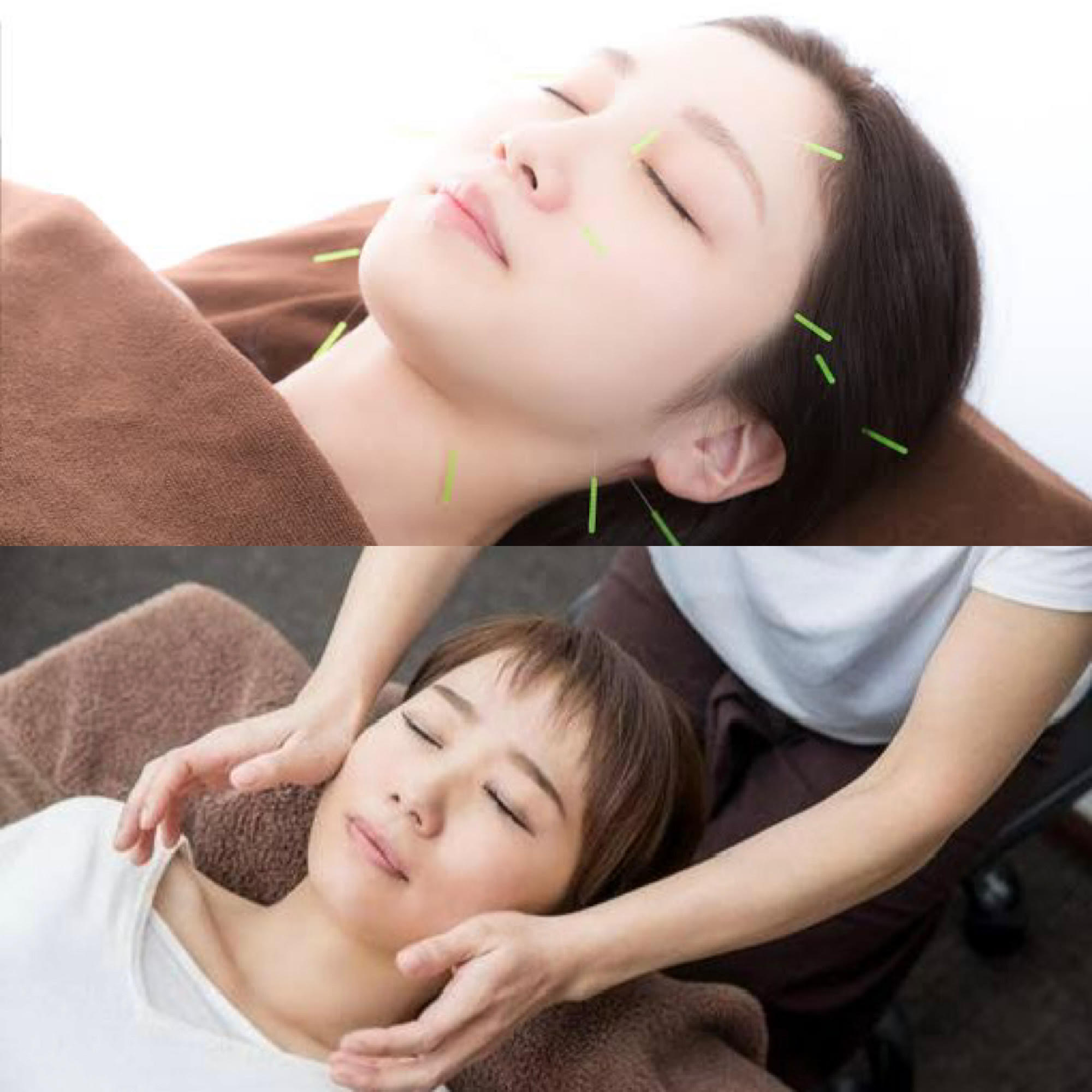 小林整骨院 深江 【お顔のことならお任せ】美容鍼×小顔矯正のメニュー画像