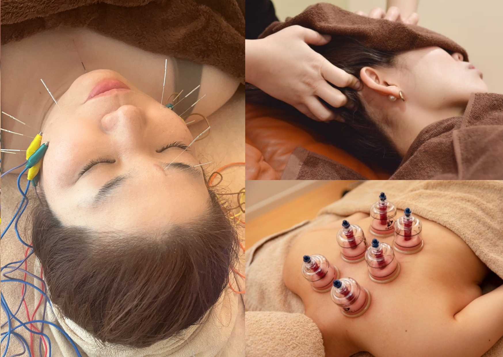 那覇鍼灸サロンrepos［ルポ］ 【初回限定】プレミアム美容鍼のメニュー画像