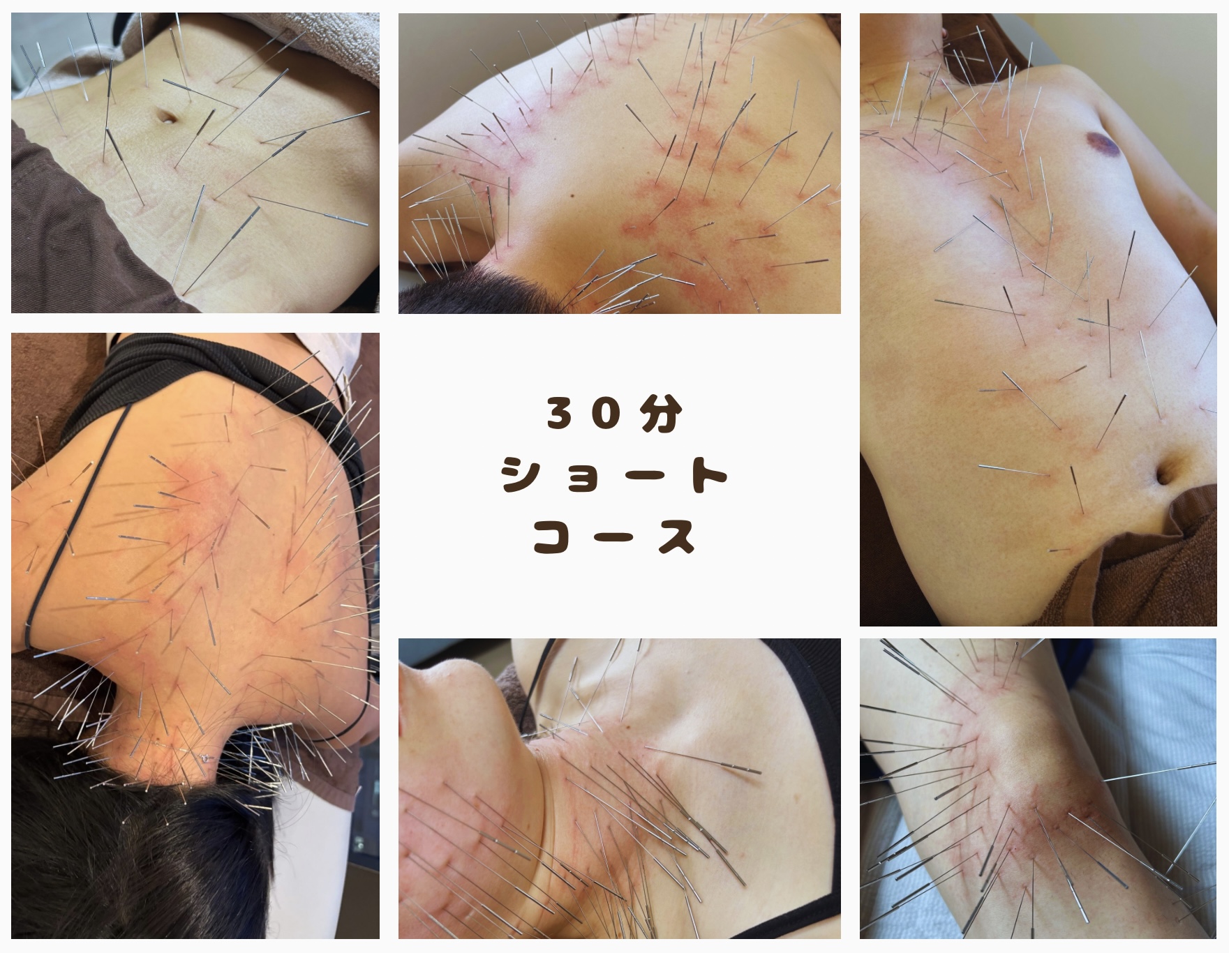 鍼処 桃 ショートコースのメニュー画像