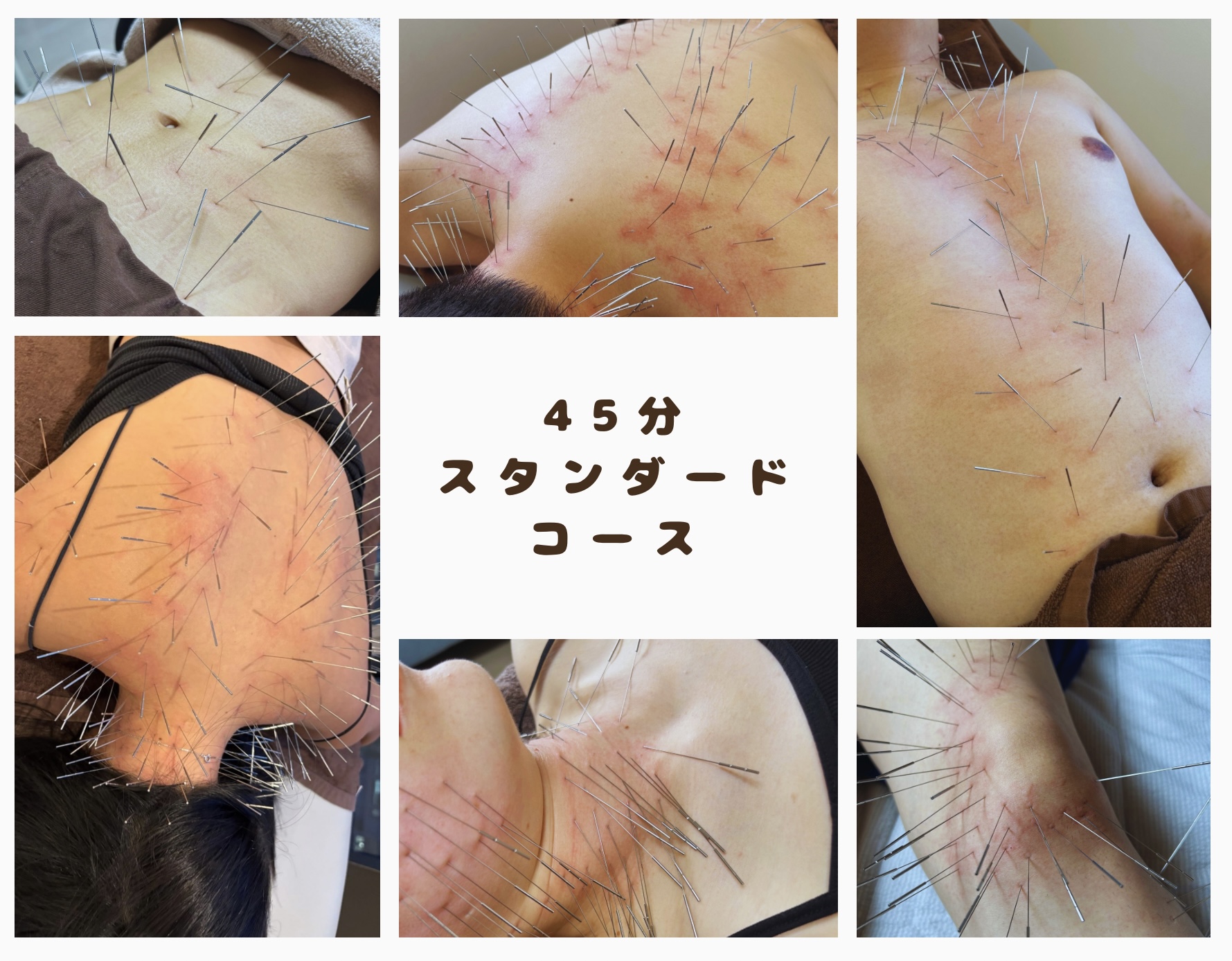 鍼処 桃 スタンダードコースのメニュー画像