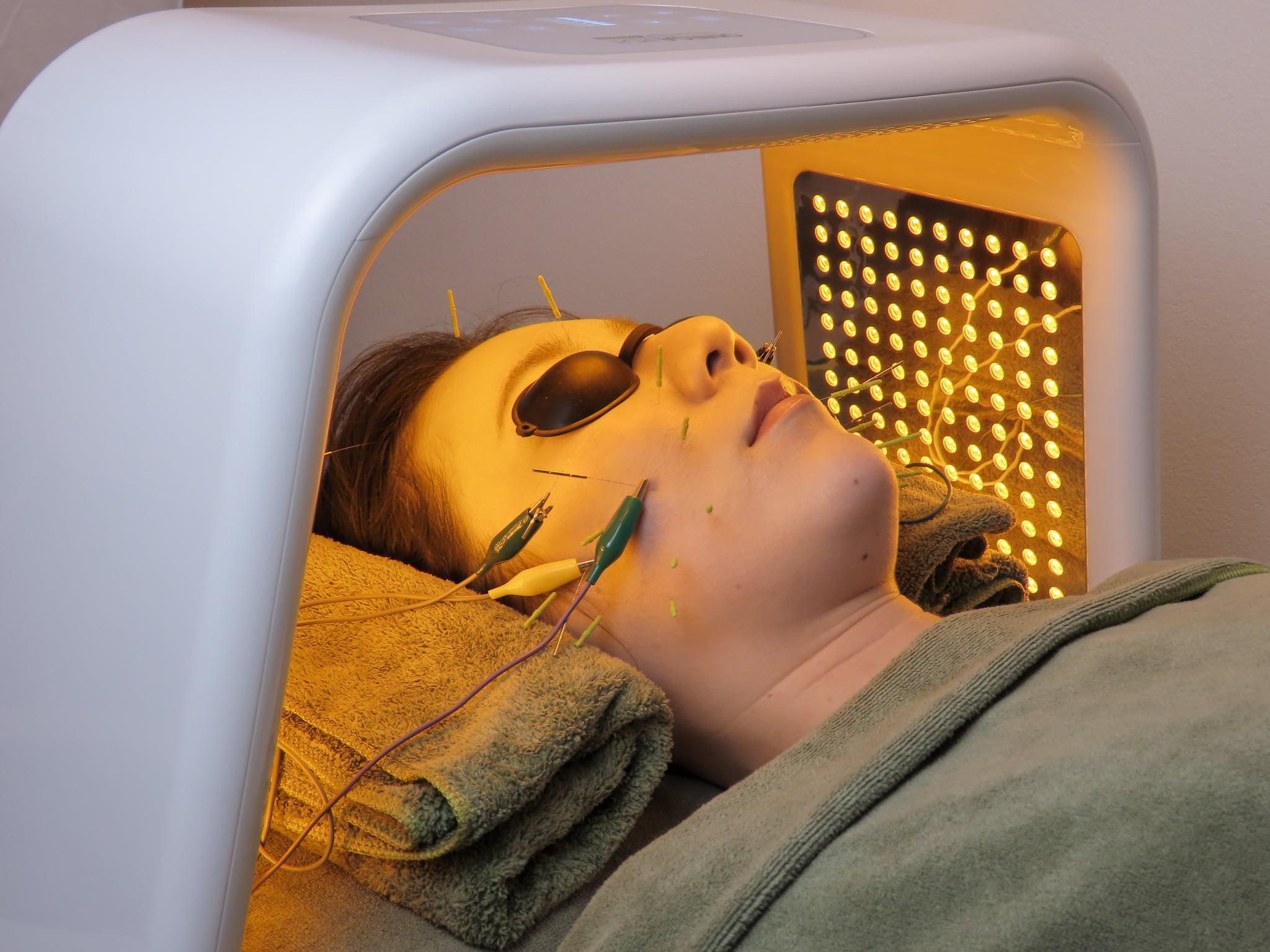 美容とカラダの鍼灸サロン やなけん 亀戸店 初回限定《エステでは変わらない深いほうれい線や毛穴に◎》炭酸パック美容鍼+LEDのメニュー画像