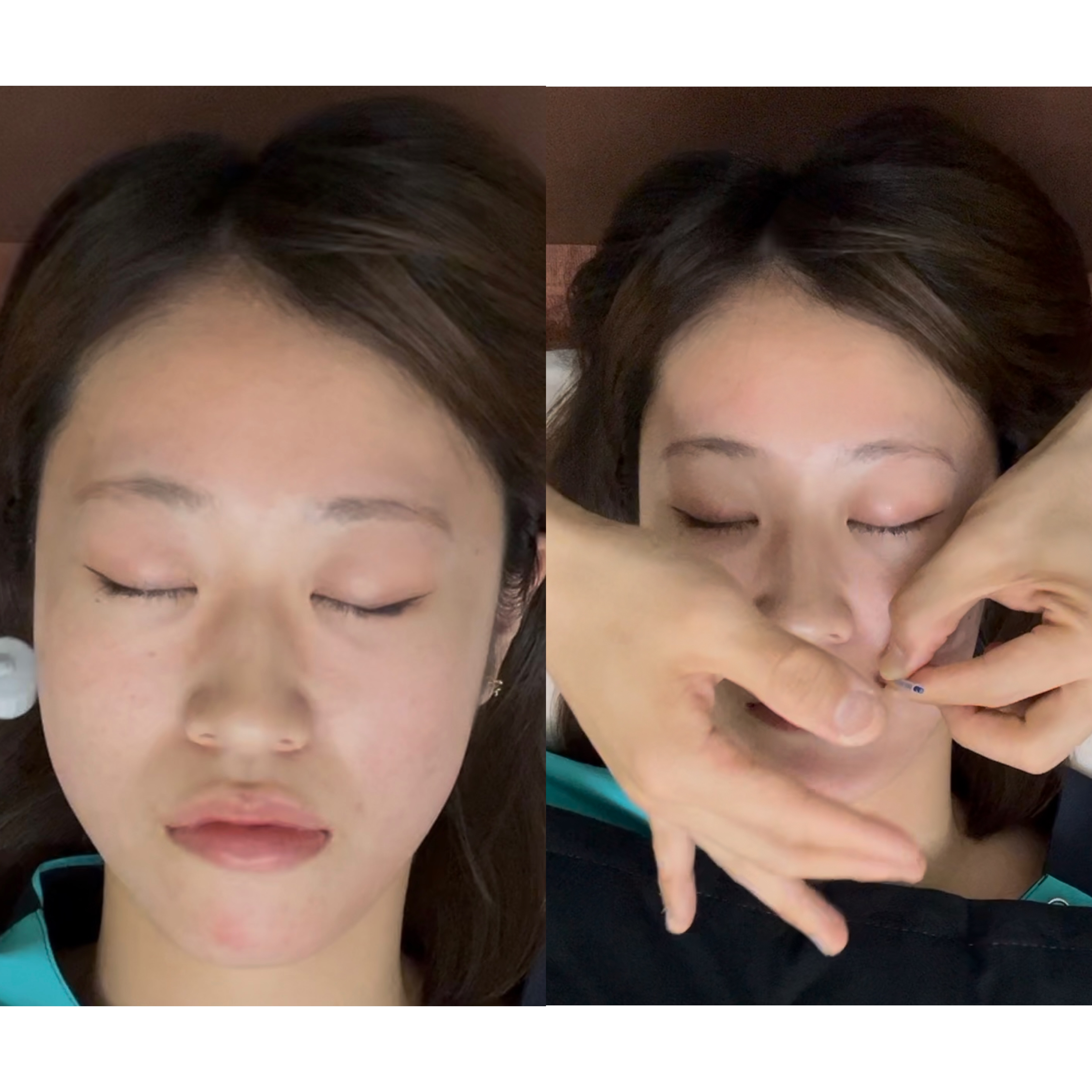 こまち鍼灸整体院Grulla 肌再生美容鍼のメニュー画像