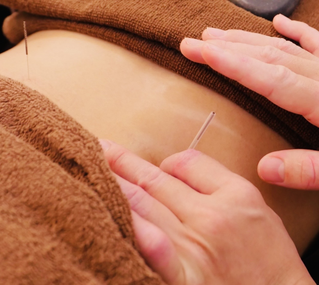 森のたきび鍼灸院　2nd 鍼灸施術60分（ショートマッサージ付き）のメニュー画像