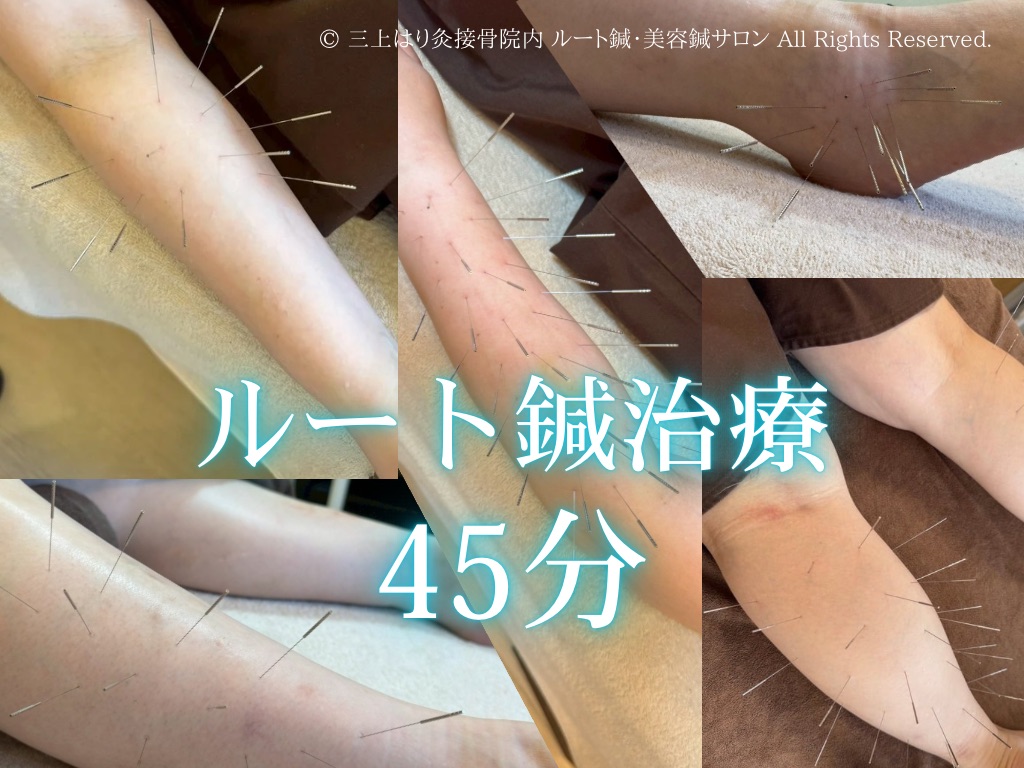三上はり灸接骨院内 ルート鍼・美容鍼サロン ルート鍼治療45分のメニュー画像
