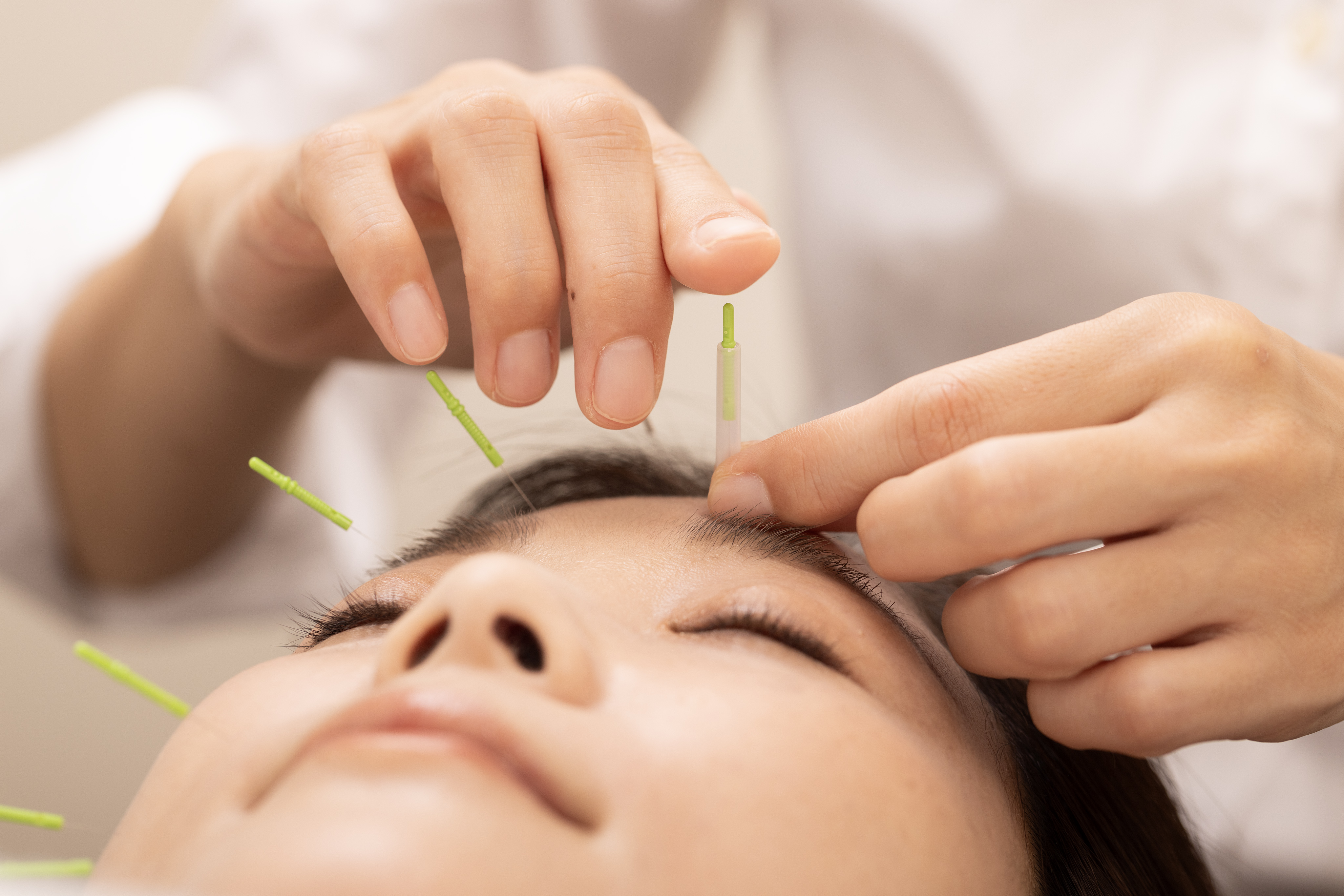 DRAGEE 美容鍼30【顔・頭・肩首のショート美容鍼】のメニュー画像