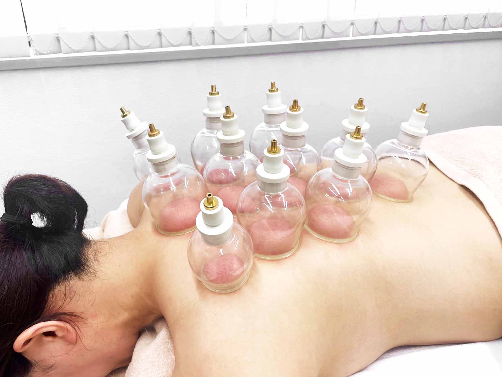 アキュモード鍼灸院 《 鍼灸＋カッピング・スタンダード》 ※初見料3,300円(税込)を含む  ※妊婦可のメニュー画像