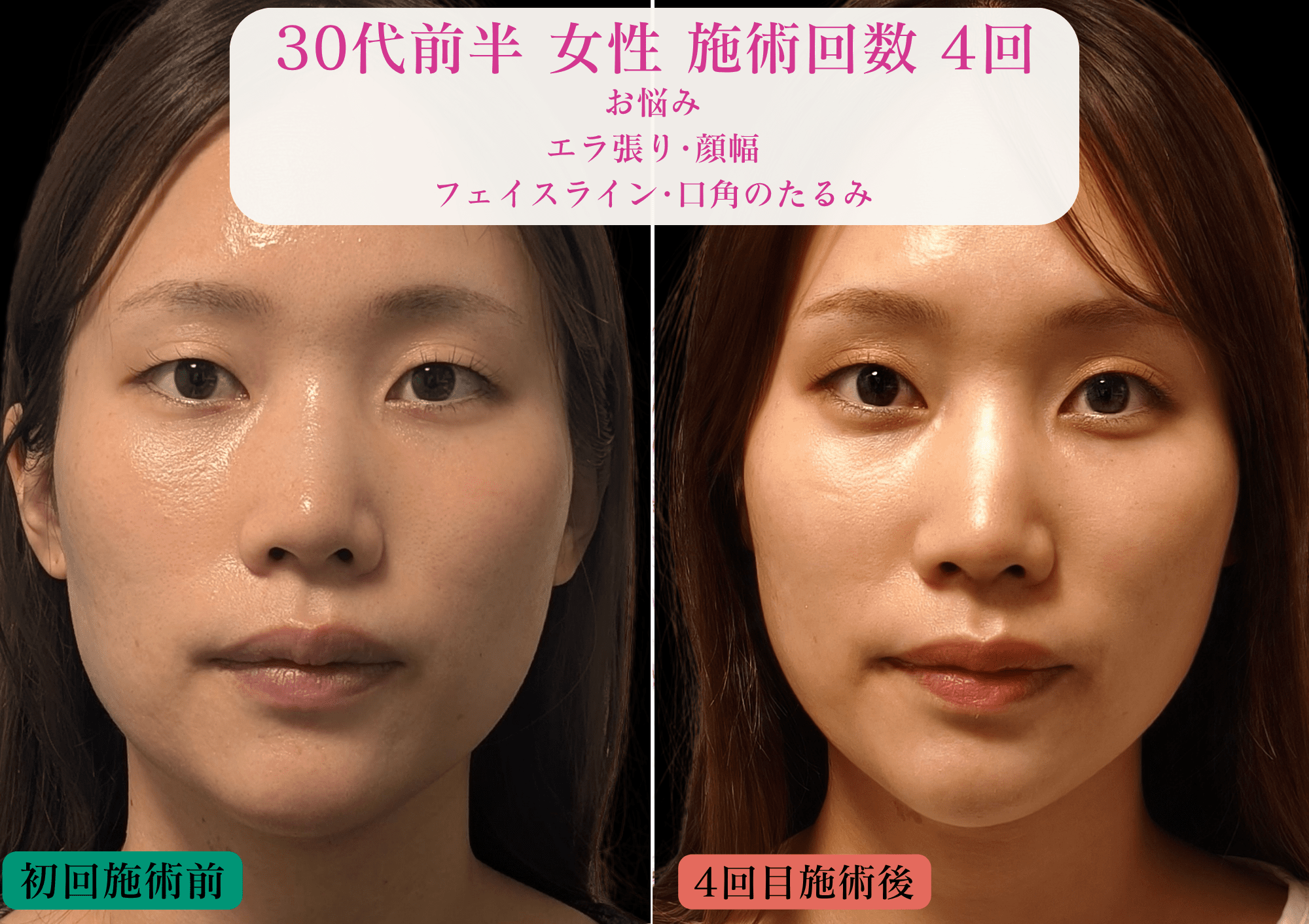 美容とカラダの鍼灸サロン やなけん 亀戸店 初回限定《10月残り1名/鏡を見るたび気になるたるみ/ほうれい線に》リフト美容鍼＋LED ¥13800 → ¥5980のメニュー画像