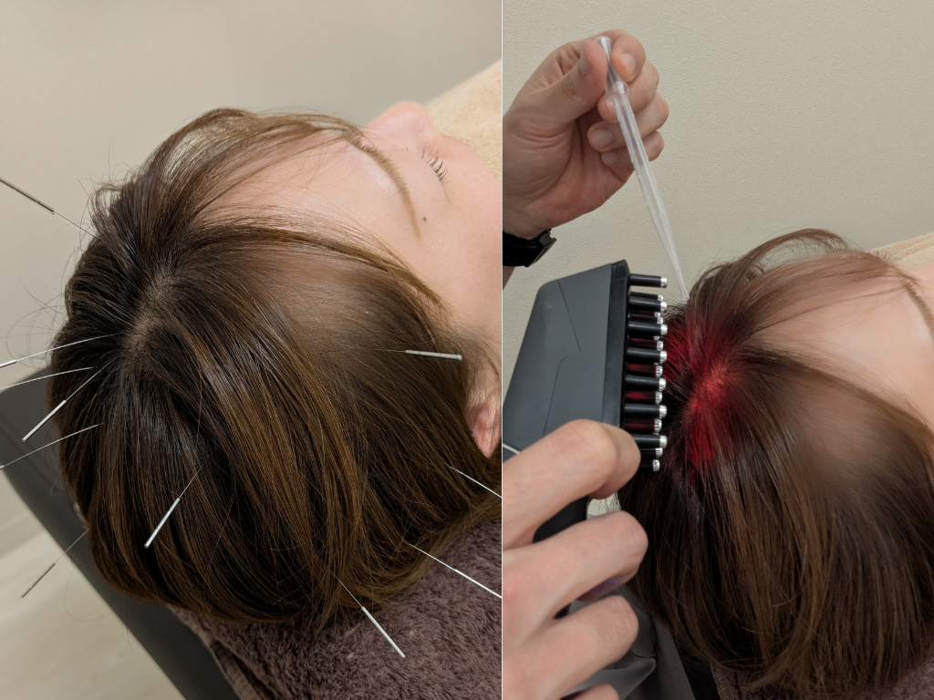 はりきゅうeFu -エフ- 【11月4日スタート！キャンペーン実施中】薄毛・育毛鍼コースのメニュー画像