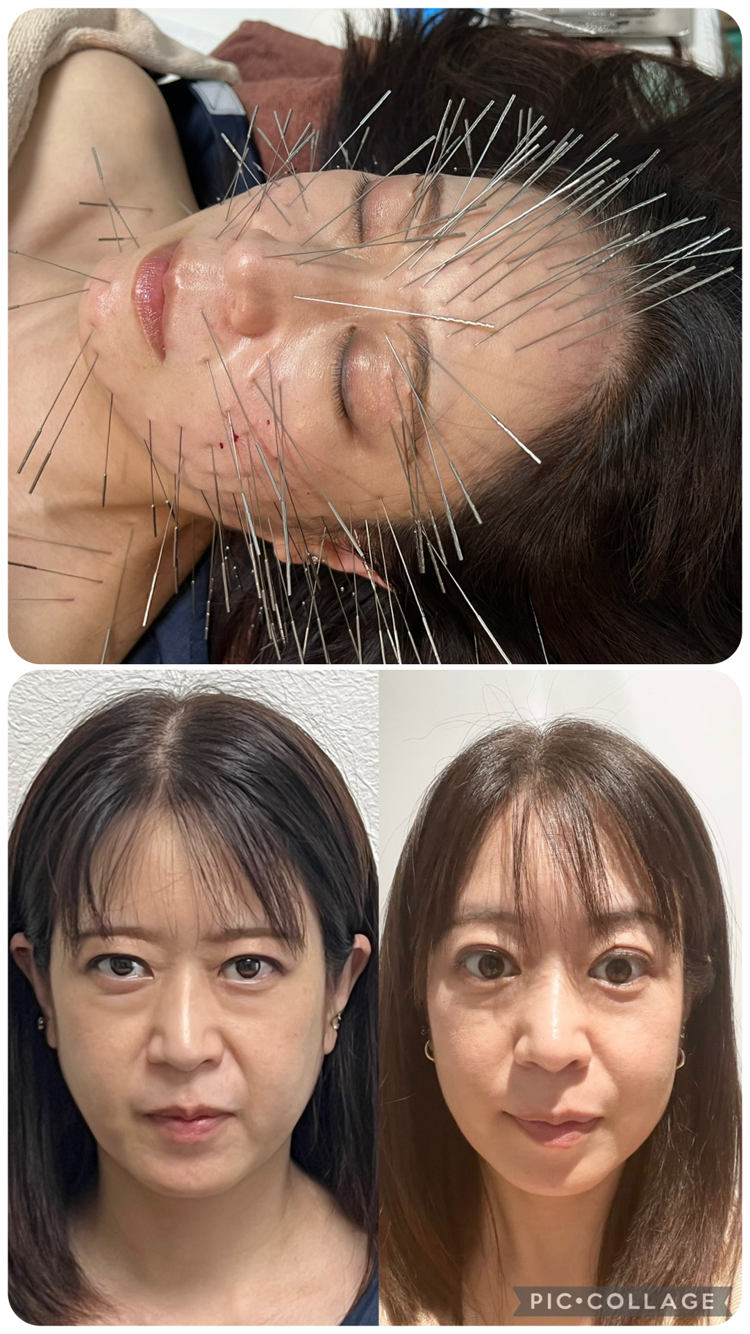 ルート治療・空ルート専門院　鍼処かなしゃ 鬼美容鍼30分コースのメニュー画像