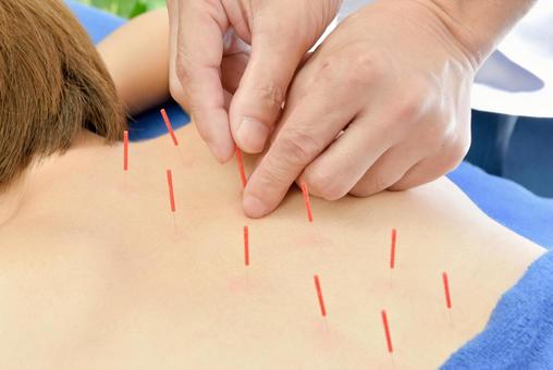 リ・ムーブ鍼灸整体院 【鍼施術初めての方へ】肩こり、腰痛、首コリなどの部分鍼灸施術　40分　4800円→2980円のメニュー画像