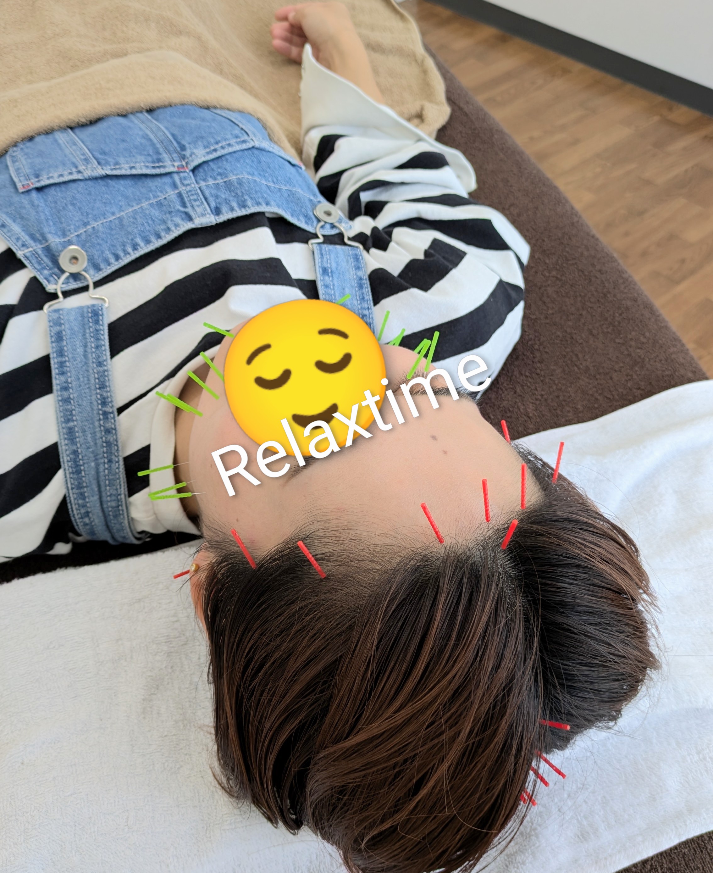 はり灸　Mysig 【期間限定】炭酸スキンケア×美容鍼灸のメニュー画像