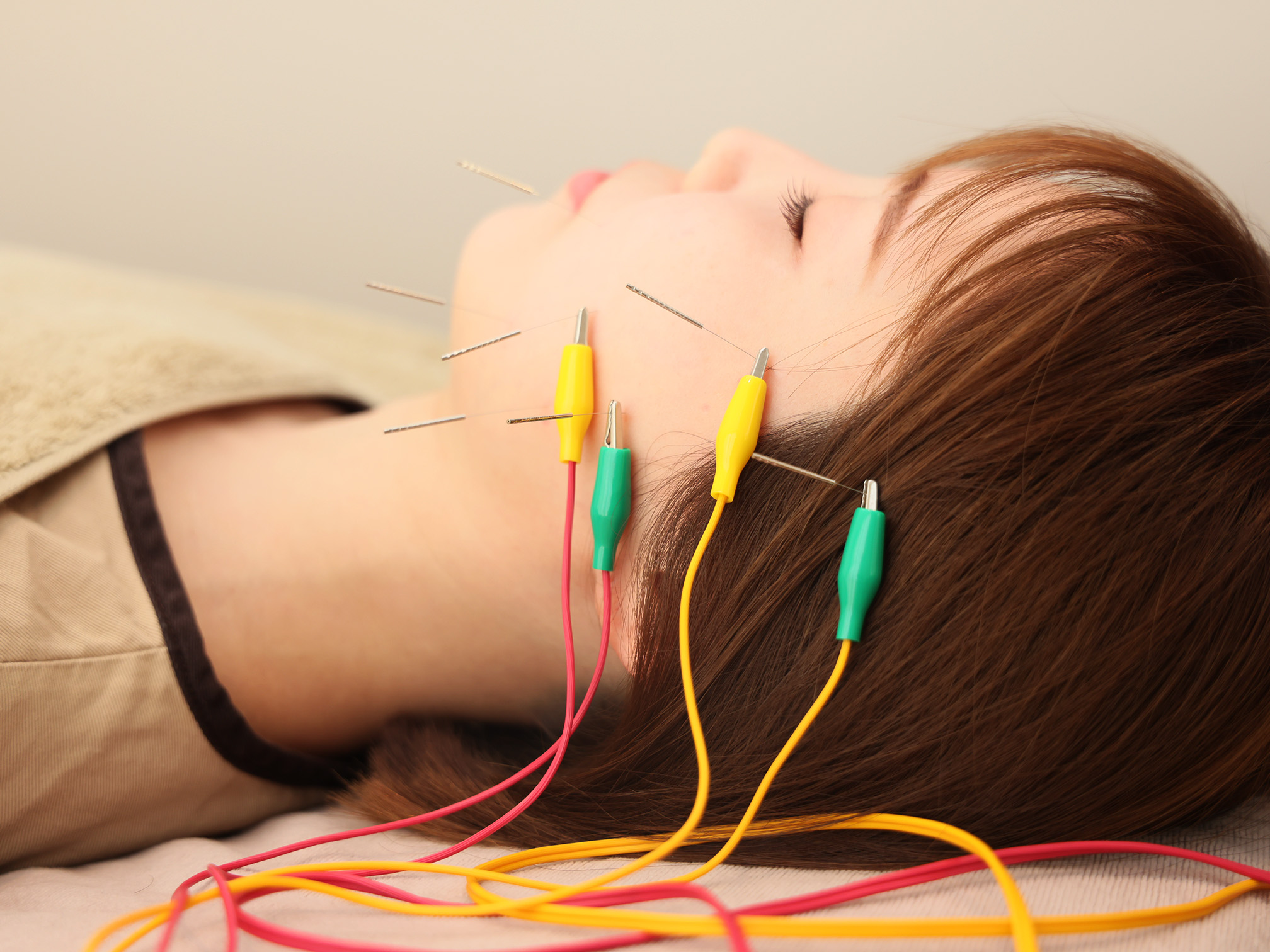 ハリノヒ大阪院 【女性人気No.2】乾燥肌・肌荒れ・ニキビケア！うるツヤ肌電気を流す美容鍼のメニュー画像