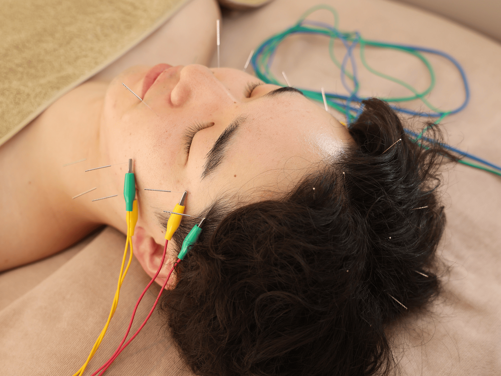 ハリノヒ大阪院 【男性人気No.2】乾燥肌・目のクマ・ニキビケア！肌荒れ改善メンズ美容鍼のメニュー画像