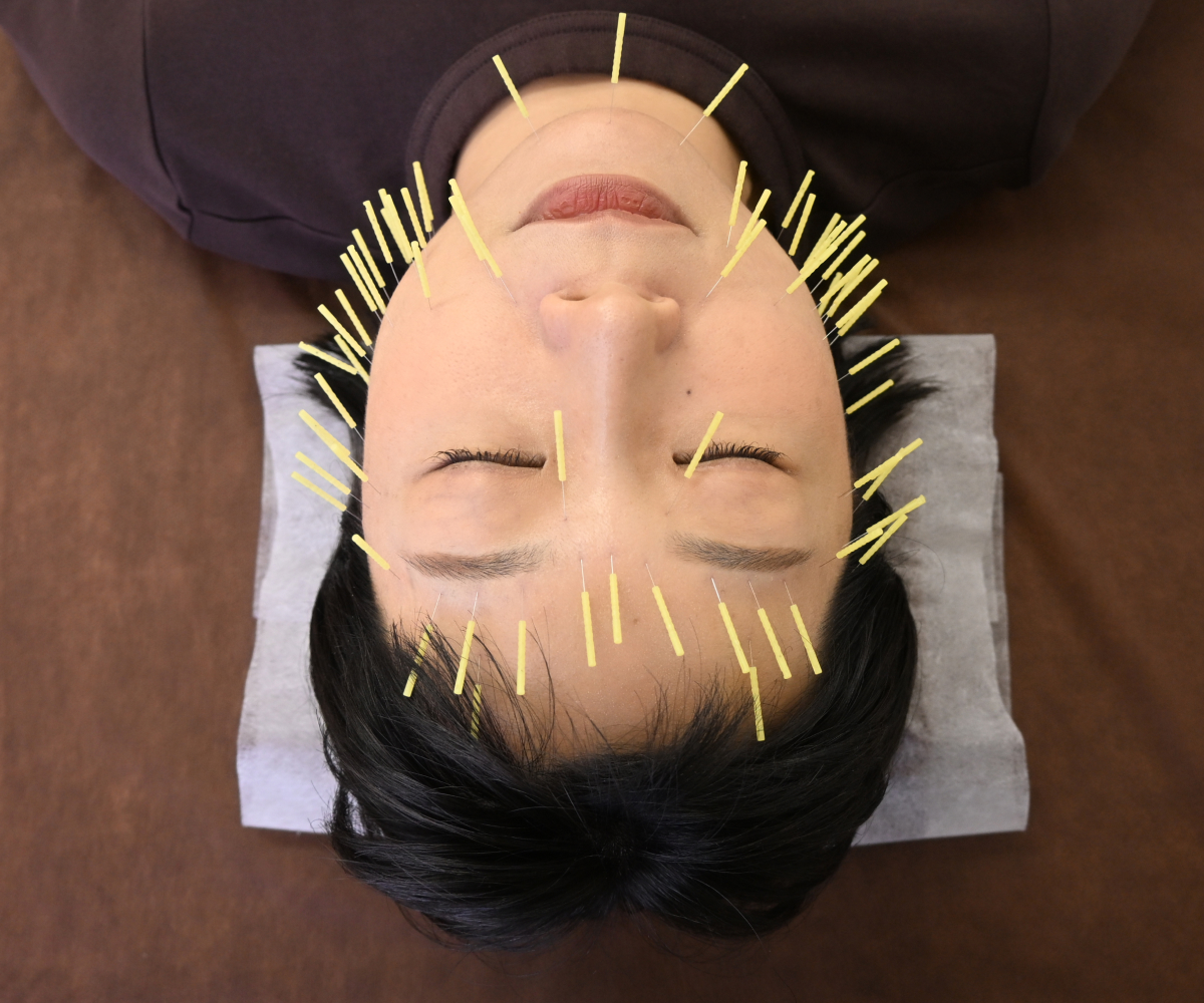 肌質改善専門 美容鍼デイジ―所沢店 まずはここから！お試し80本コースのメニュー画像