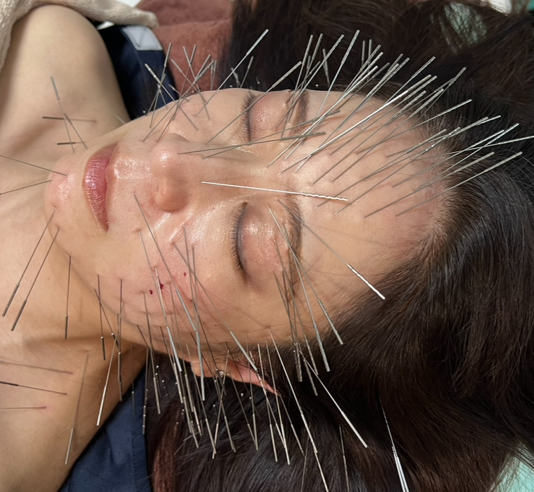 ルート治療・空ルート専門院　鍼処かなしゃ モニターメニュー空ルート＆鬼美容鍼+小顔メソッドのメニュー画像