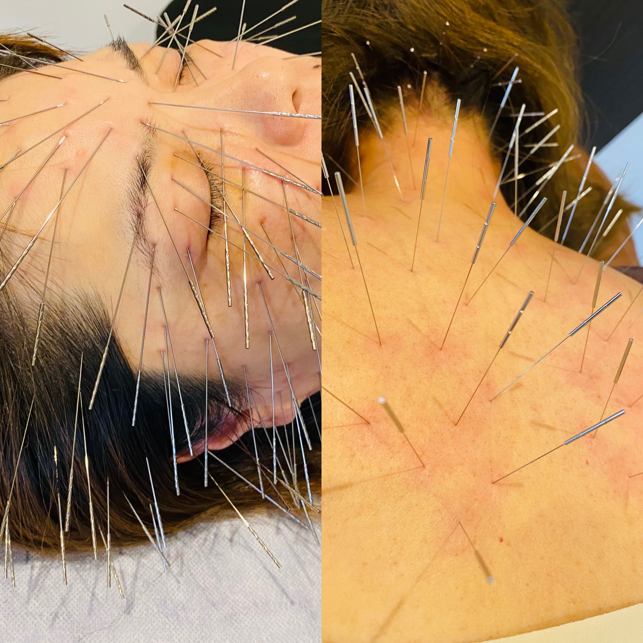 長﨑鍼療院【ルート治療認定院】 ルート鬼美容鍼(スタンダード)のメニュー画像