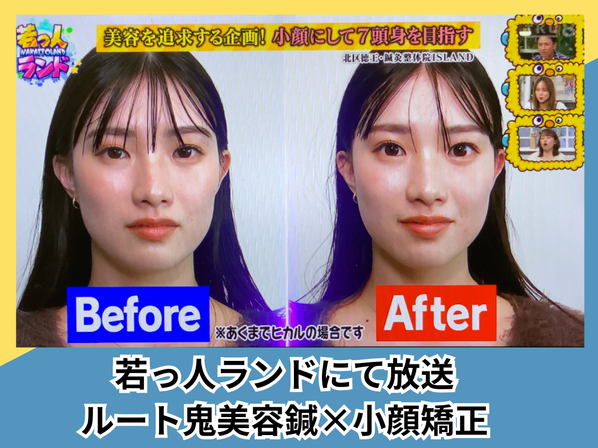 鍼灸整体院ISLAND ルート鬼美容鍼×小顔矯正　《鍼100本程度》　8,000円のメニュー画像