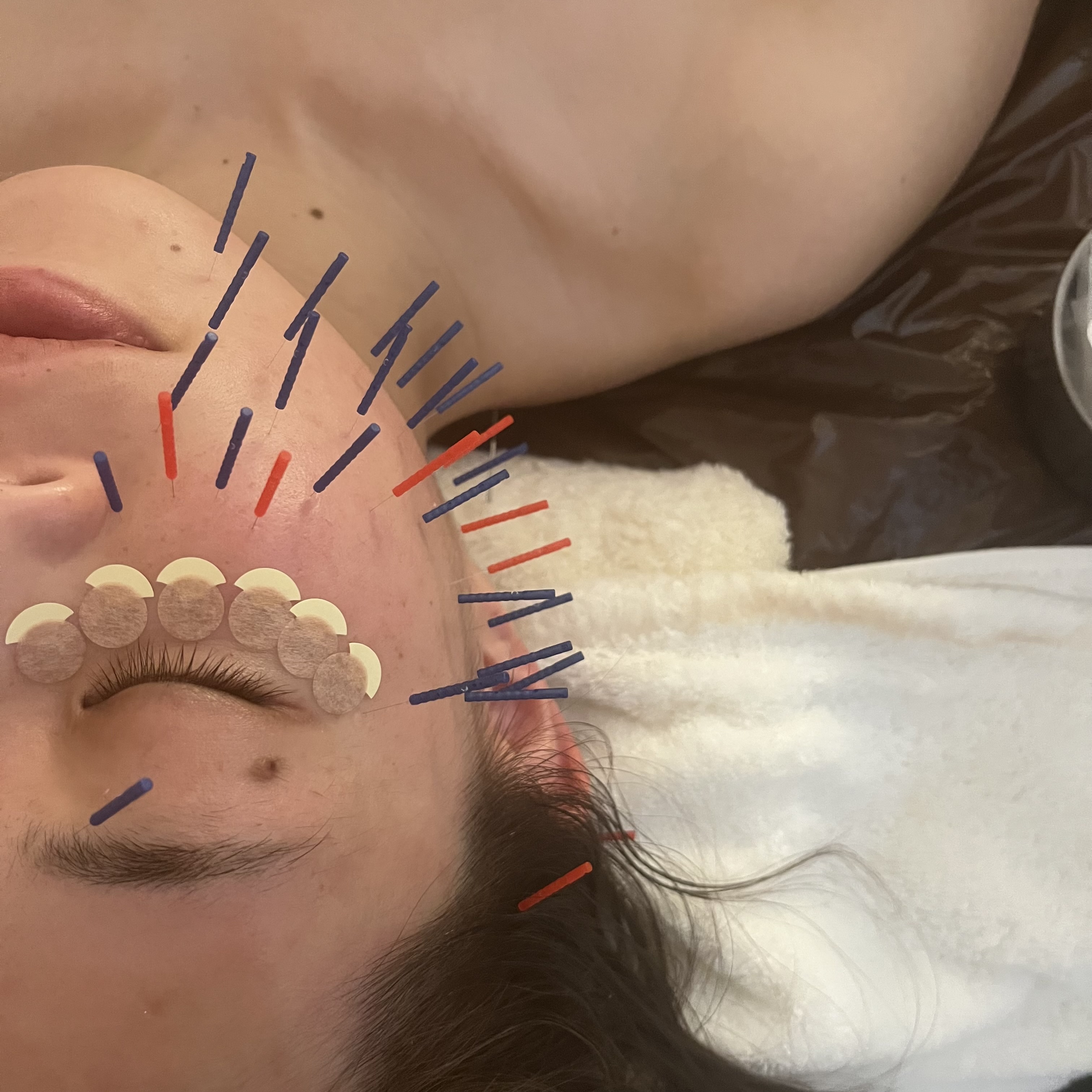 鍼灸院 Anju 肌質改善トリートメントのメニュー画像