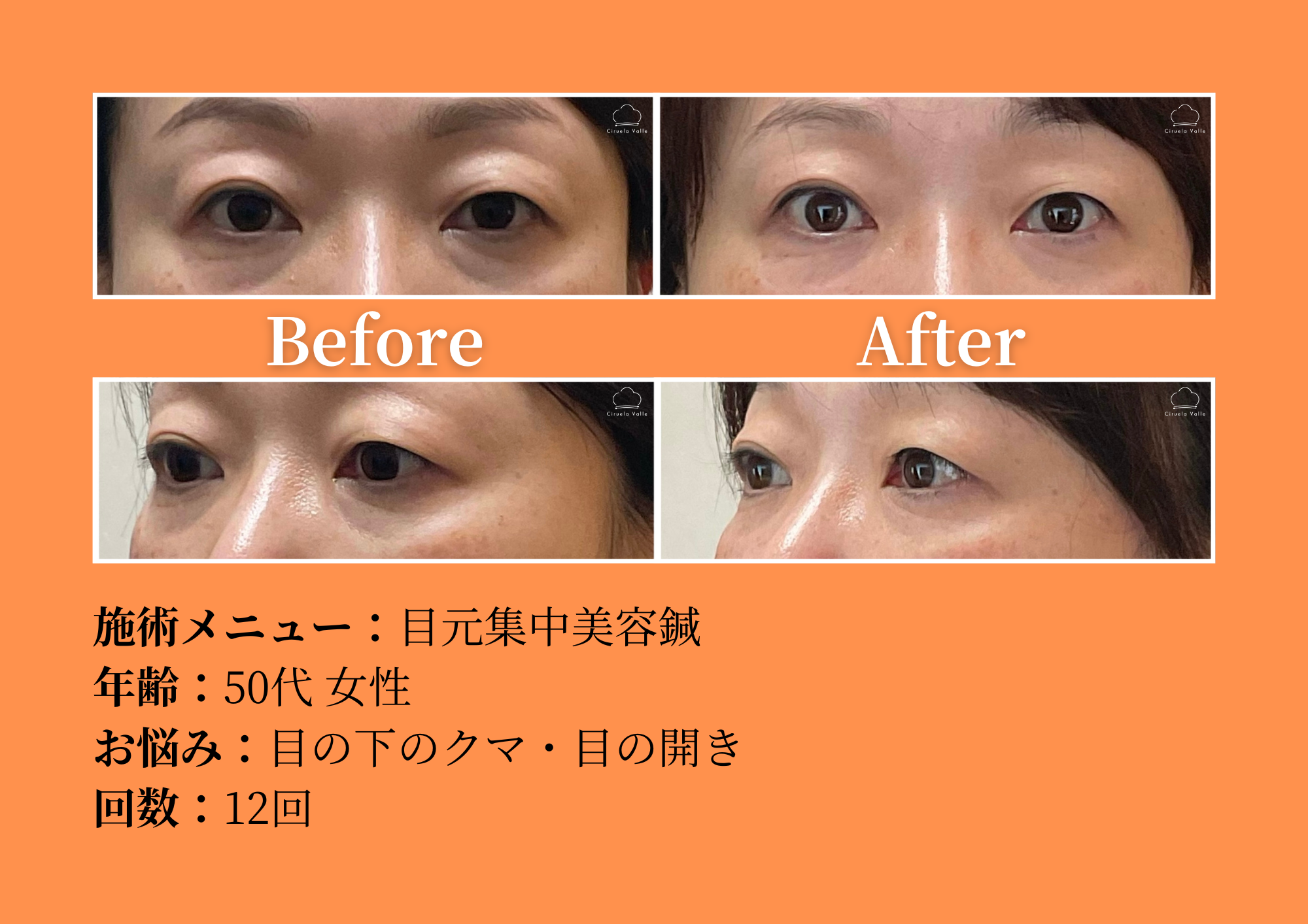 −美容鍼・小顔専門−鍼灸CiruelaValle 【残り1名】『目元特化美容鍼』通常15000円→初回2000円のメニュー画像