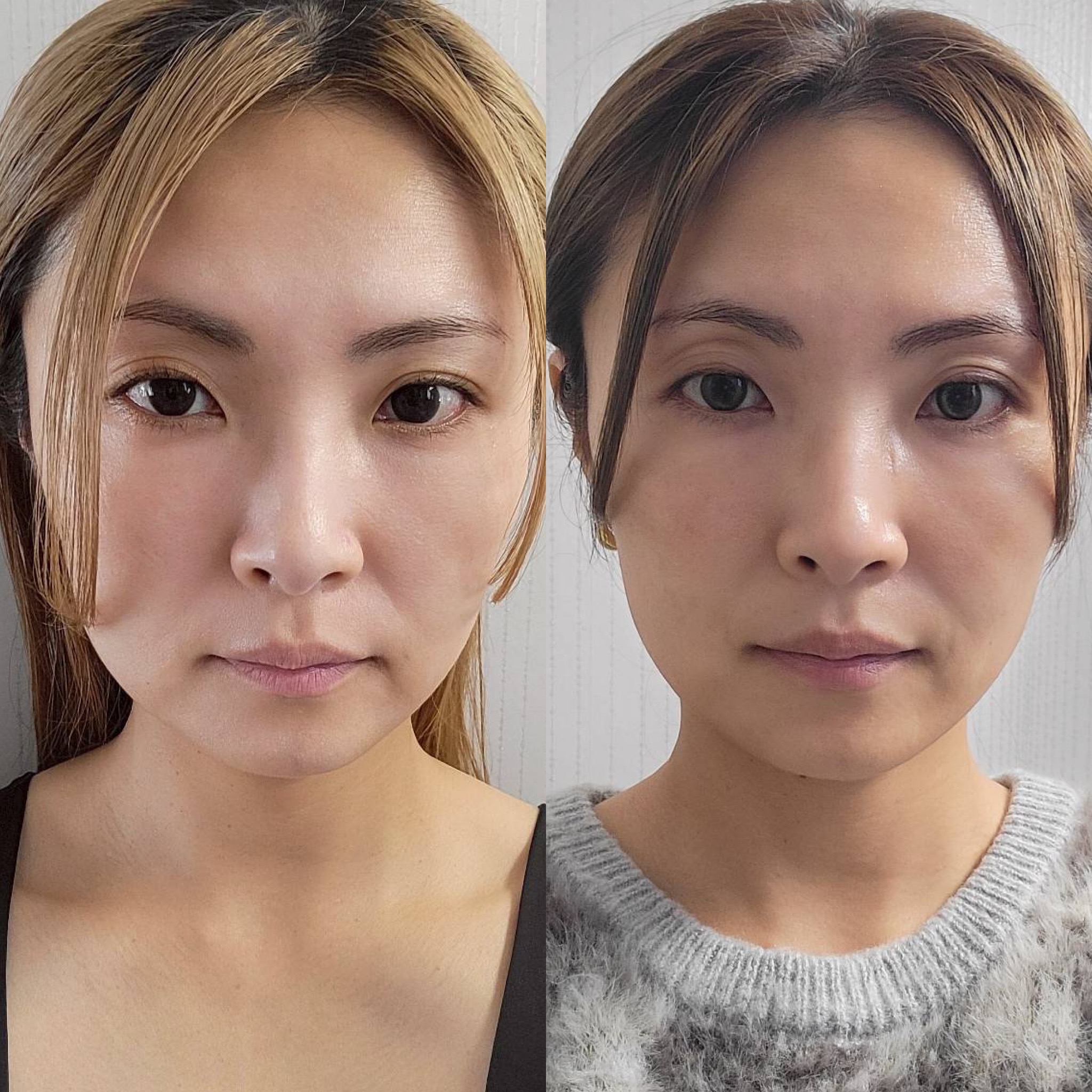 長﨑鍼療院【ルート治療認定院】 ルート鬼美容鍼(ショート)のメニュー画像