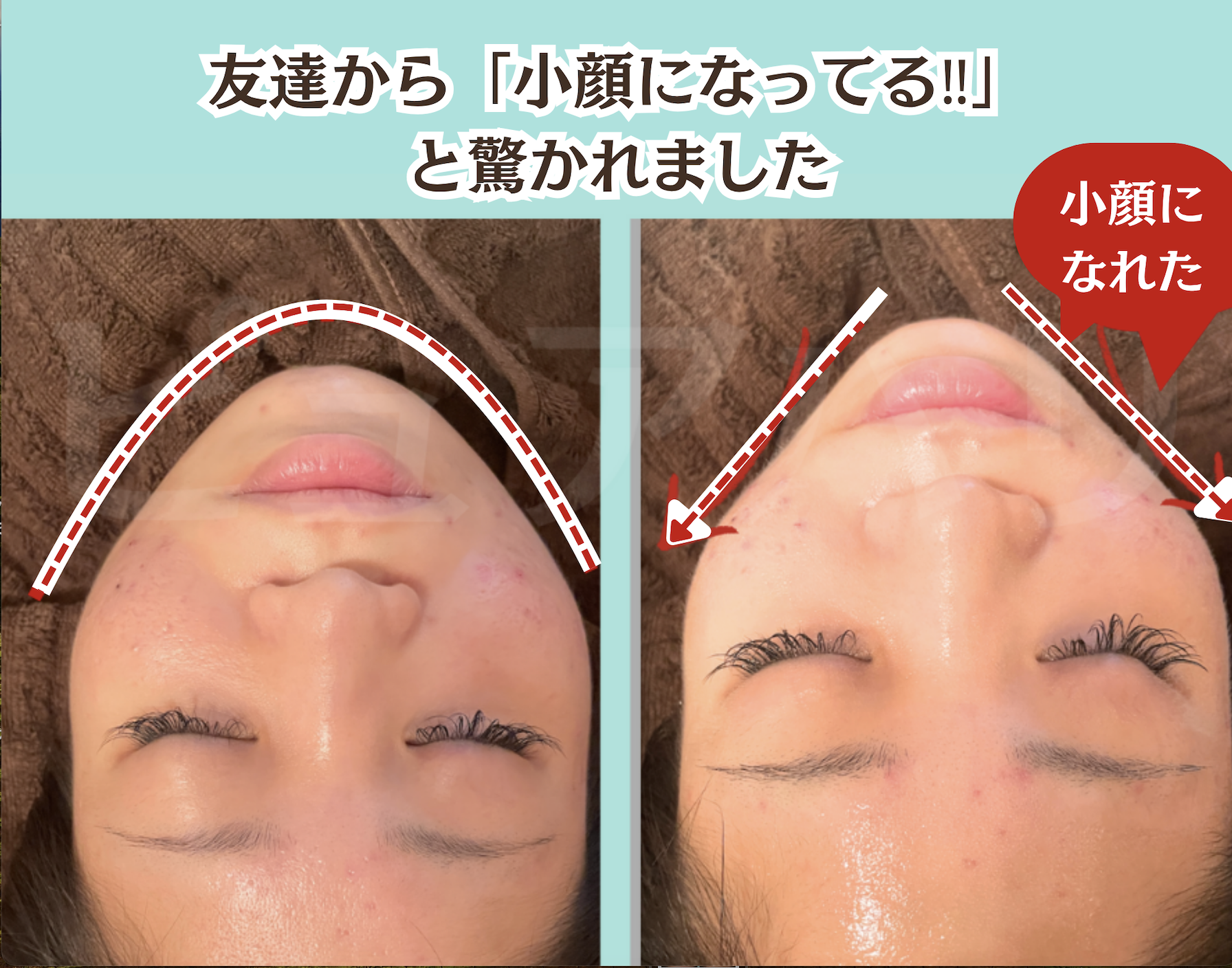 ピュアハリ美容鍼サロン 【リフトアップ/小顔効果に◎】5タイプ骨格診断＋ 美容鍼60分打ち放題のメニュー画像