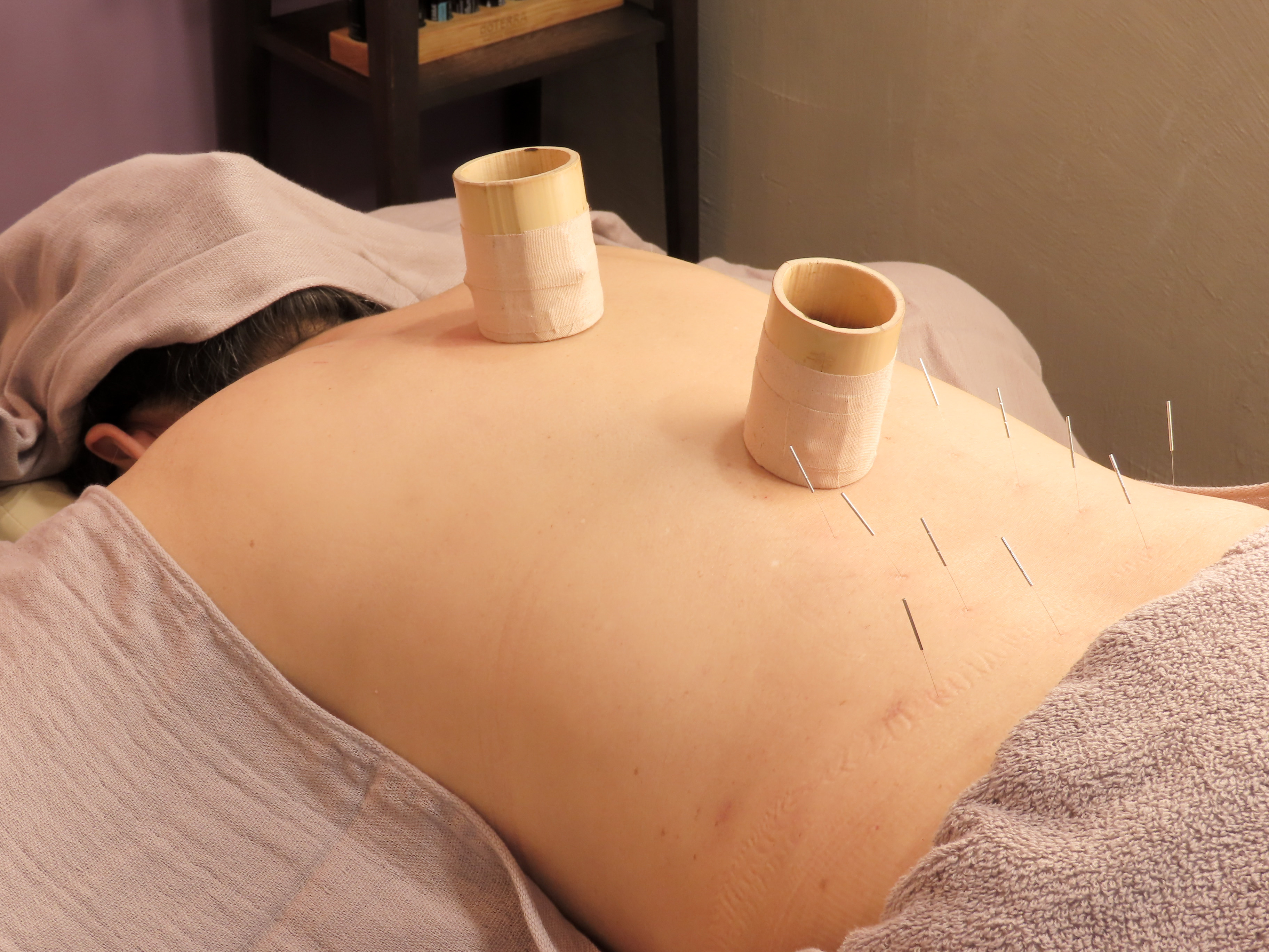 東麻布aman鍼灸サロン 【初めての方限定】取りきれない疲れと体質改善に　aman全身鍼灸のメニュー画像